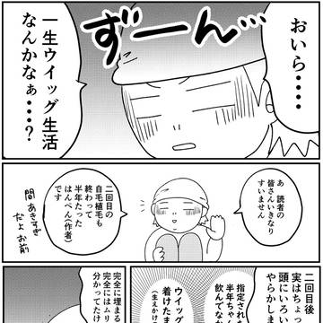自毛植毛2年と半年